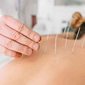 Acupuncture
